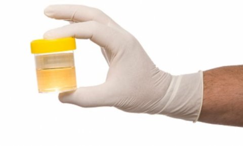 urin obloge opekotine narodni lijek