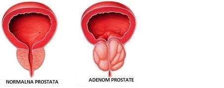 prostata adenom